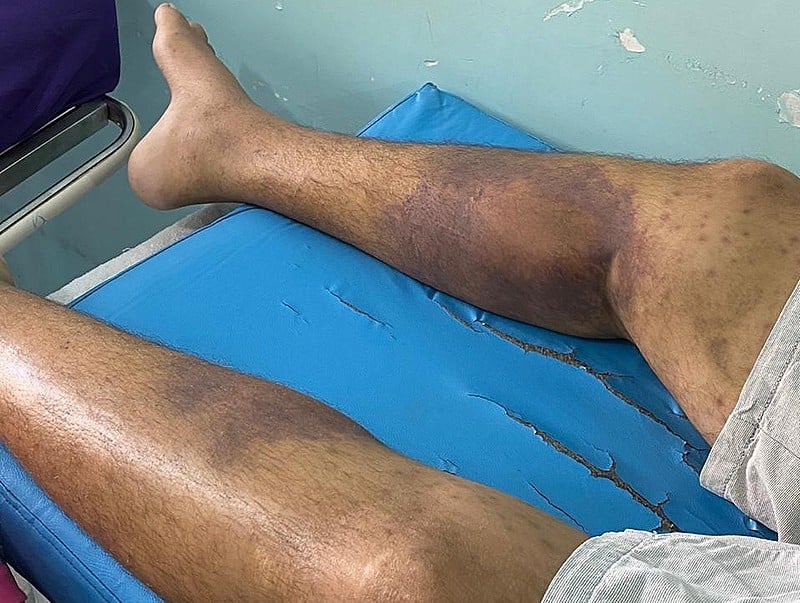 A infecção de pele causada por bactérias, segundo a Secretaria Estadual de Saúde de Roraima, é resultante de uma sarna não tratada