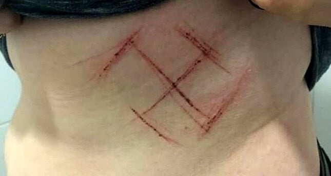 Três homens cortaram uma suástica na barriga de uma mulher, que vestia um adesivo #Elenão, em Porto Alegre (RS).