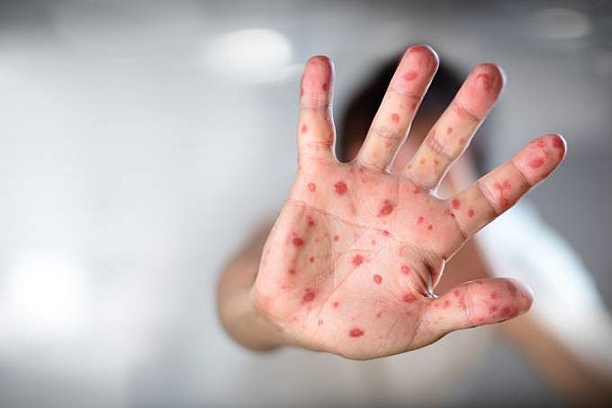 Todos até 29 anos devem ter duas doses para garantir a imunidade