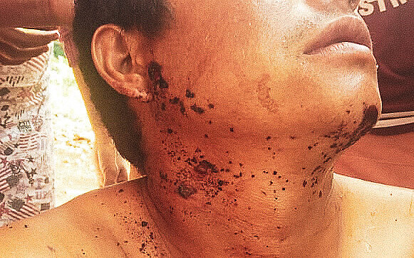 Indígena da retomada Nhu Vera ferido por bala de borracha