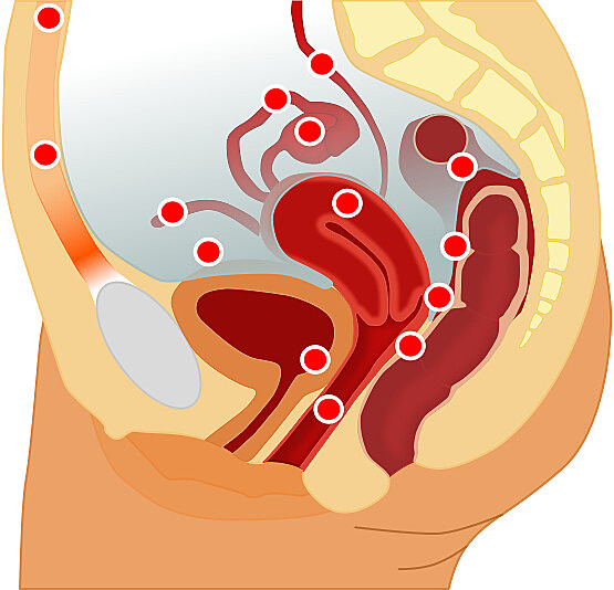 Uma a cada dez mulheres do mundo, com idades entre 15 e 45 anos, tem endometriose