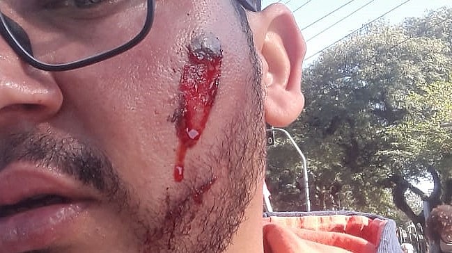 Um rapaz que estava no ato da USP, pela manhã, foi atingido no rosto por um estilhaço de bomba jogada pela polícia militar