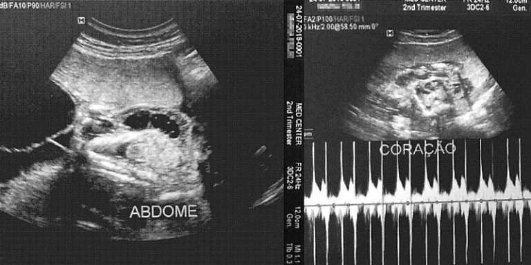 Um aborto a cada quatro grávidas: a cidade em que o glifosato mata quem não nasceu