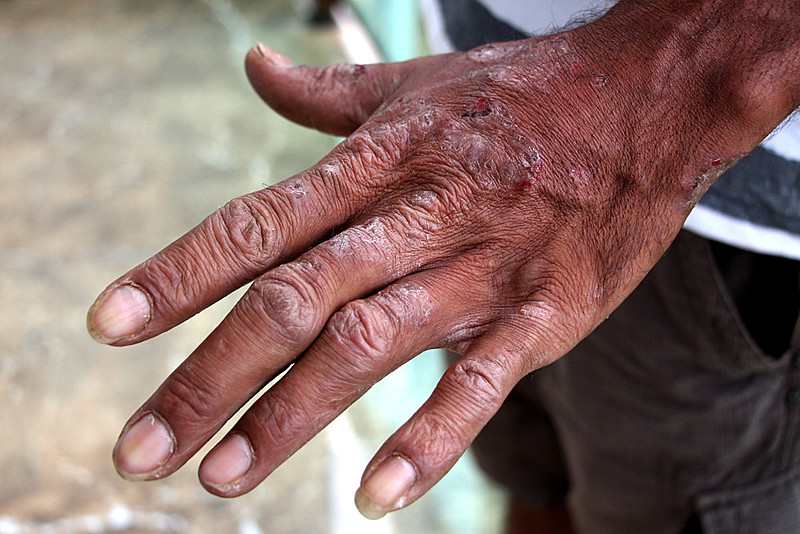 Após o rompimento da barragem muitas pessoas começaram a apresentar problemas comuns, respiratórios, dermatológicos e psicológicos